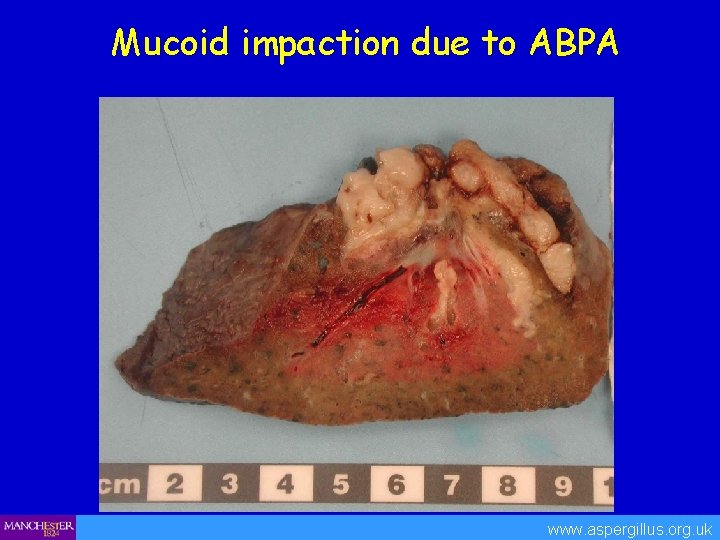Mucoid impaction due to ABPA www. aspergillus. org. uk 
