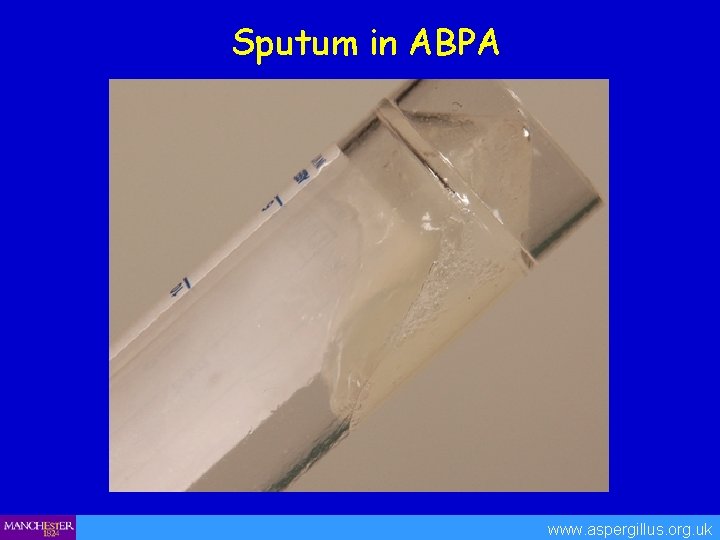 Sputum in ABPA www. aspergillus. org. uk 