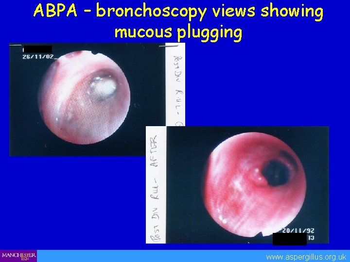 ABPA – bronchoscopy views showing mucous plugging www. aspergillus. org. uk 