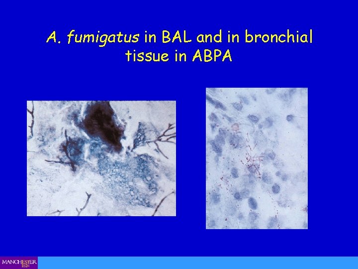 A. fumigatus in BAL and in bronchial tissue in ABPA 