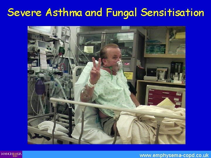Severe Asthma and Fungal Sensitisation www. emphysema-copd. co. uk 
