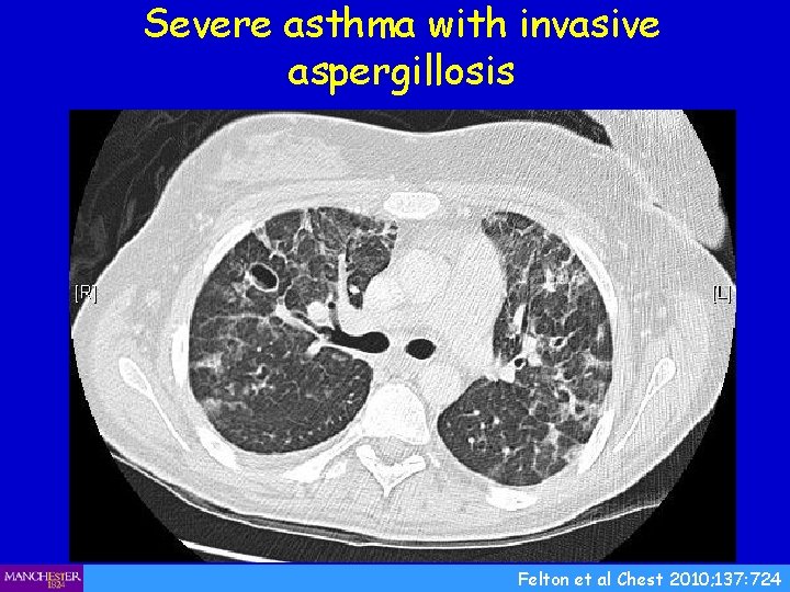 Severe asthma with invasive aspergillosis Felton et al Chest 2010; 137: 724 