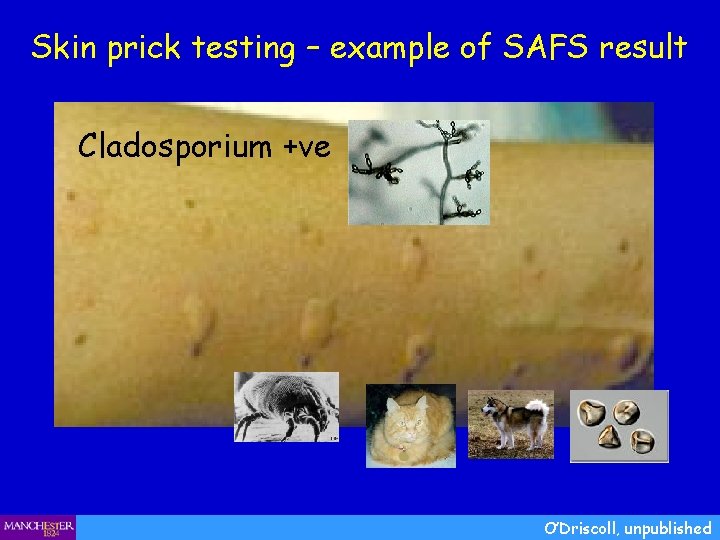Skin prick testing – example of SAFS result Cladosporium +ve O’Driscoll, unpublished 