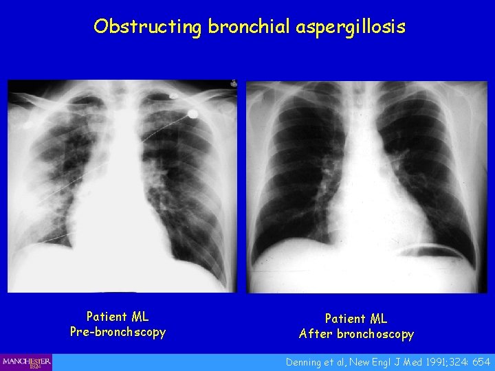 Obstructing bronchial aspergillosis Patient ML Pre-bronchscopy Patient ML After bronchoscopy Denning et al, New
