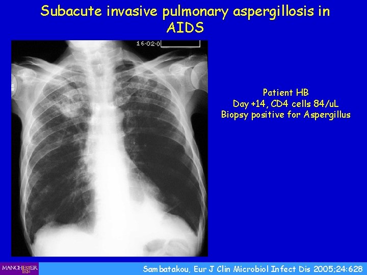 Subacute invasive pulmonary aspergillosis in AIDS Patient HB Day +14, CD 4 cells 84/u.