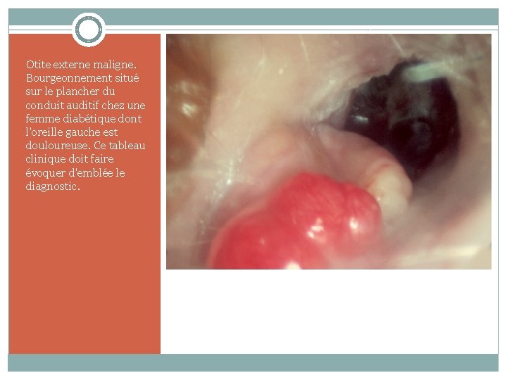 Otite externe maligne. Bourgeonnement situé sur le plancher du conduit auditif chez une femme