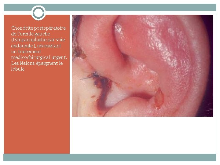 Chondrite postopératoire de l'oreille gauche (tympanoplastie par voie endaurale), nécessitant un traitement médicochirurgical urgent.