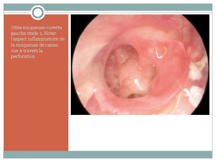 Otite muqueuse ouverte gauche stade 1. Noter l'aspect inflammatoire de la muqueuse de caisse