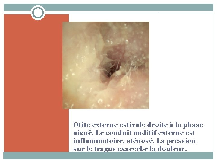 Otite externe estivale droite à la phase aiguë. Le conduit auditif externe est inflammatoire,