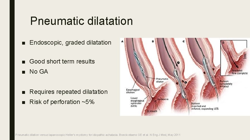 Pneumatic dilatation ■ Endoscopic, graded dilatation ■ Good short term results ■ No GA
