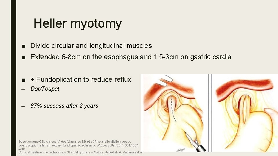 Heller myotomy ■ Divide circular and longitudinal muscles ■ Extended 6 -8 cm on