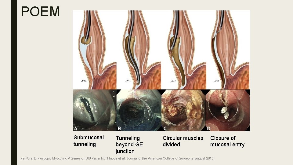 POEM Submucosal tunneling Tunneling beyond GE junction Circular muscles divided Closure of mucosal entry