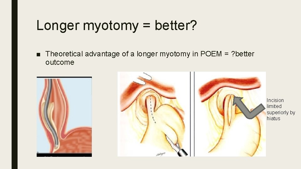 Longer myotomy = better? ■ Theoretical advantage of a longer myotomy in POEM =