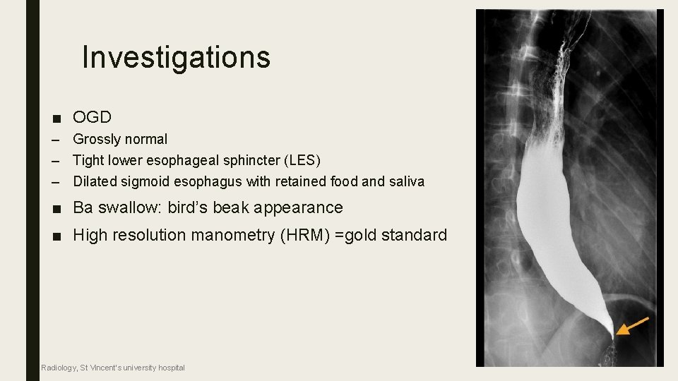 Investigations ■ OGD – Grossly normal – Tight lower esophageal sphincter (LES) – Dilated