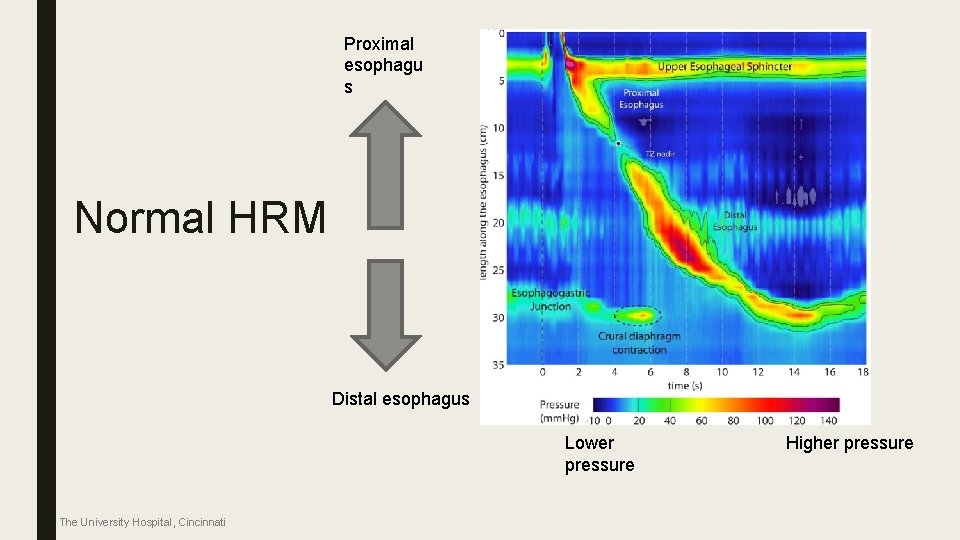 Proximal esophagu s Normal HRM Distal esophagus Lower pressure The University Hospital, Cincinnati Higher