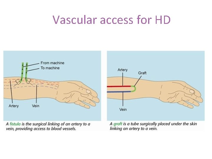 Vascular access for HD 