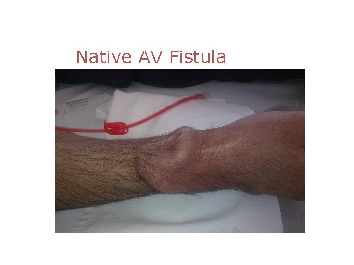 Native AV Fistula 
