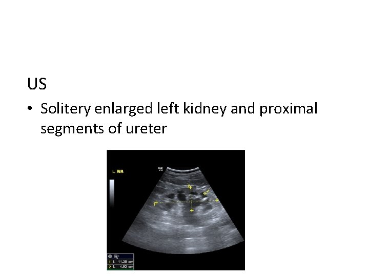 US • Solitery enlarged left kidney and proximal segments of ureter 