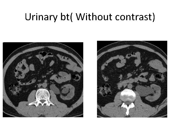 Urinary bt( Without contrast) 