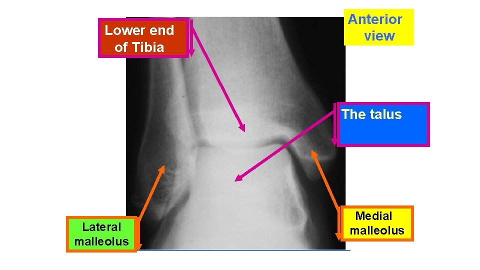 Lower end of Tibia Anterior view The talus Lateral malleolus Medial malleolus 