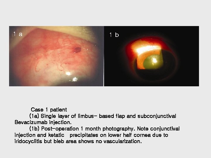 Two Cases of Subconjunctival Bevacizumab Injection to Prevent