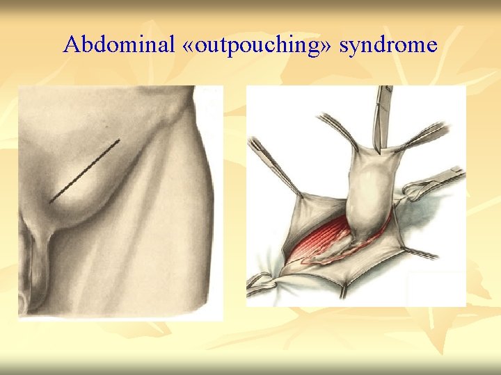 Abdominal «outpouching» syndrome 