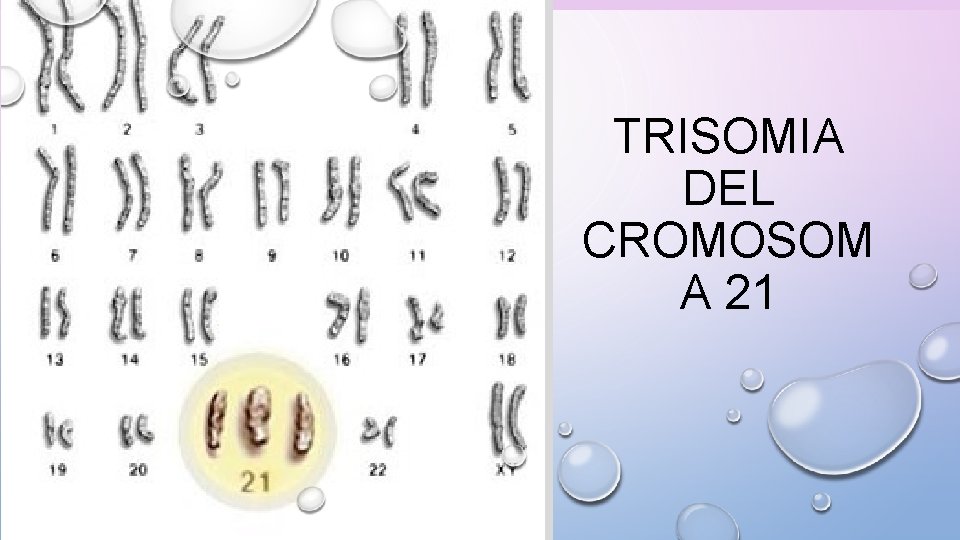 TRISOMIA DEL CROMOSOM A 21 