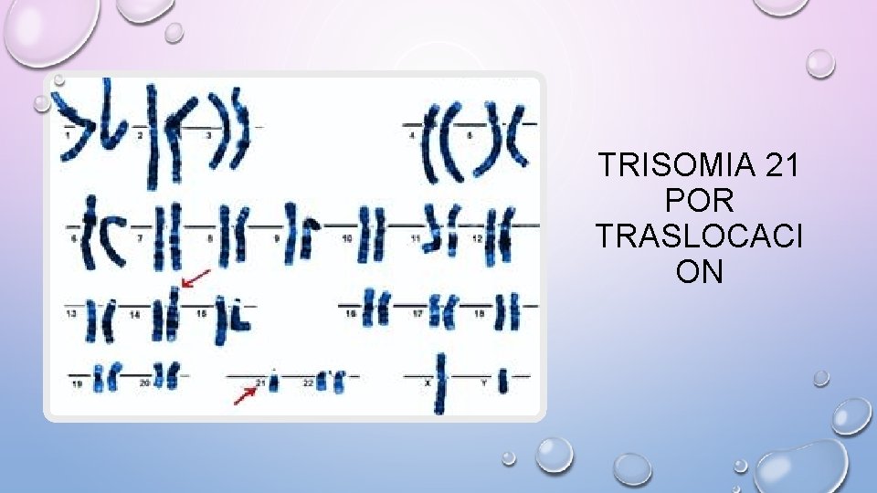 TRISOMIA 21 POR TRASLOCACI ON 