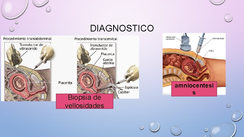 DIAGNOSTICO Biopsia de vellosidades amniocentesi s 