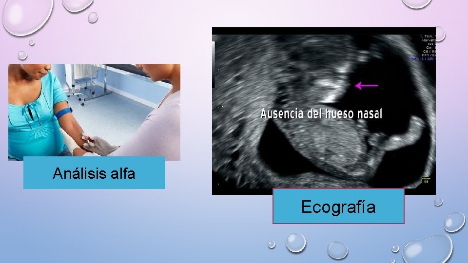 Análisis alfa Ecografía 