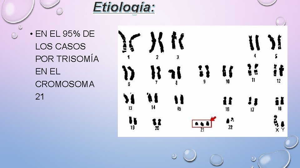 Etiología: • EN EL 95% DE LOS CASOS POR TRISOMÍA EN EL CROMOSOMA 21