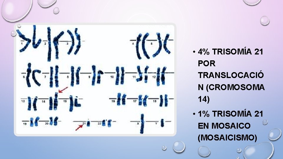  • 4% TRISOMÍA 21 POR TRANSLOCACIÓ N (CROMOSOMA 14) • 1% TRISOMÍA 21