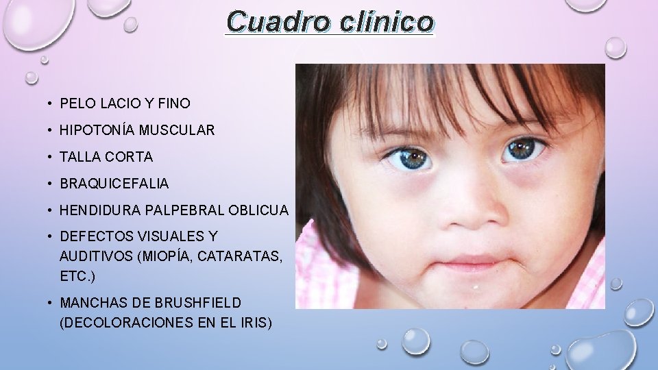 Cuadro clínico • PELO LACIO Y FINO • HIPOTONÍA MUSCULAR • TALLA CORTA •