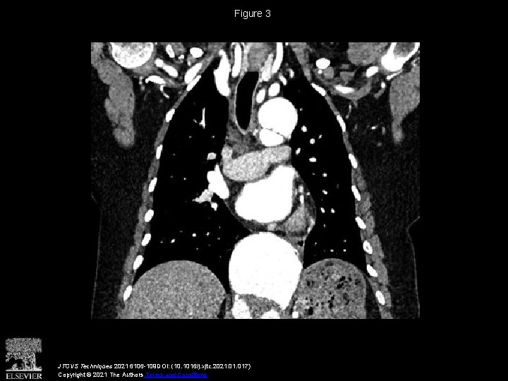 Figure 3 JTCVS Techniques 2021 6106 -109 DOI: (10. 1016/j. xjtc. 2021. 017) Copyright