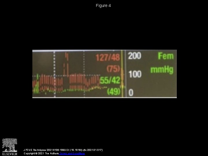 Figure 4 JTCVS Techniques 2021 6106 -109 DOI: (10. 1016/j. xjtc. 2021. 017) Copyright