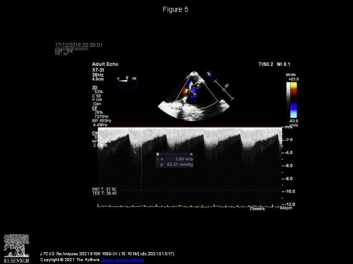 Figure 5 JTCVS Techniques 2021 6106 -109 DOI: (10. 1016/j. xjtc. 2021. 017) Copyright