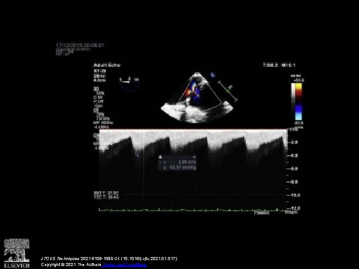 JTCVS Techniques 2021 6106 -109 DOI: (10. 1016/j. xjtc. 2021. 017) Copyright © 2021