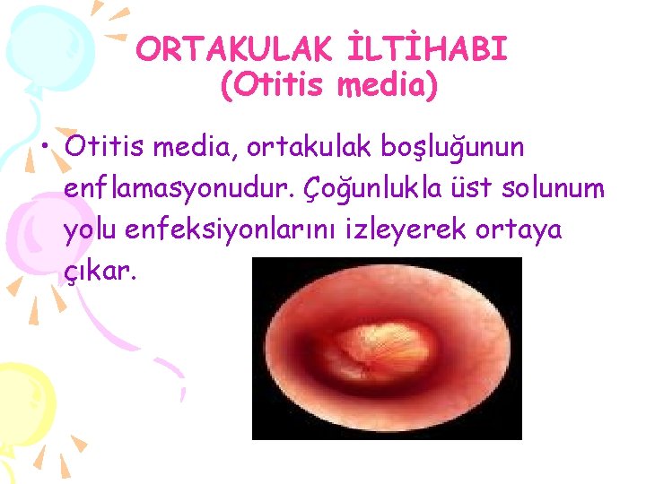 ORTAKULAK İLTİHABI (Otitis media) • Otitis media, ortakulak boşluğunun enflamasyonudur. Çoğunlukla üst solunum yolu