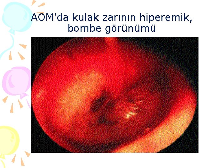 AOM'da kulak zarının hiperemik, bombe görünümü 