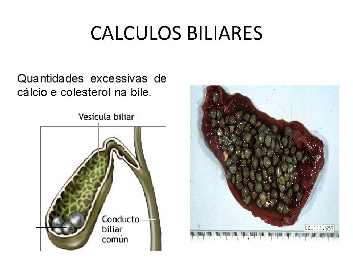 CALCULOS BILIARES Quantidades excessivas de cálcio e colesterol na bile. 