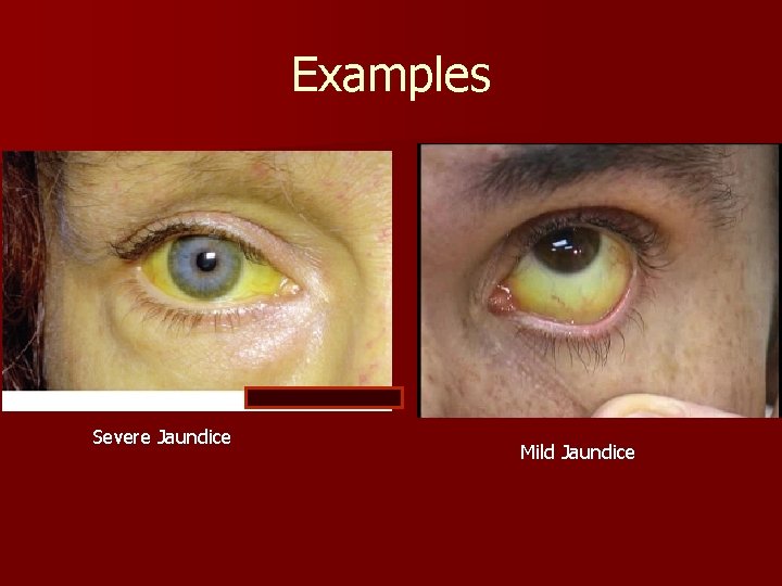Examples Severe Jaundice Mild Jaundice 