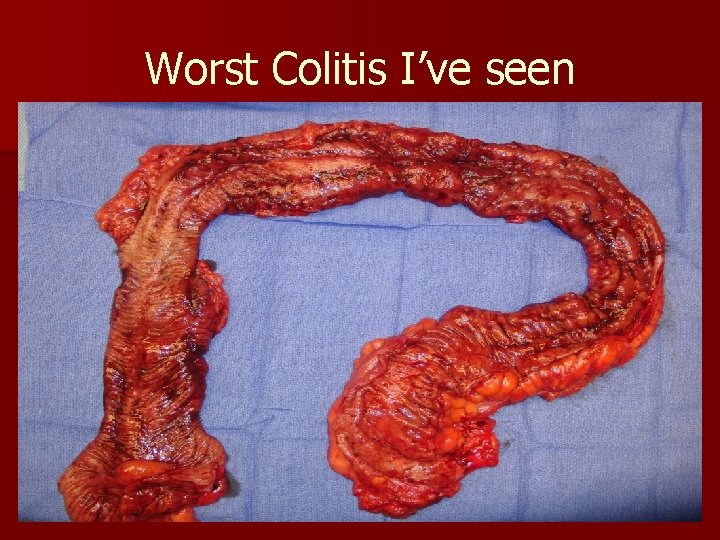 Worst Colitis I’ve seen 