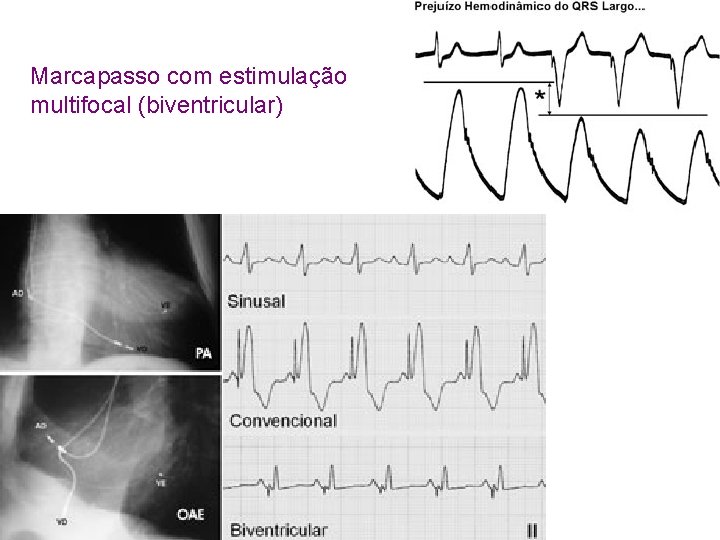 Marcapasso com estimulação multifocal (biventricular) 