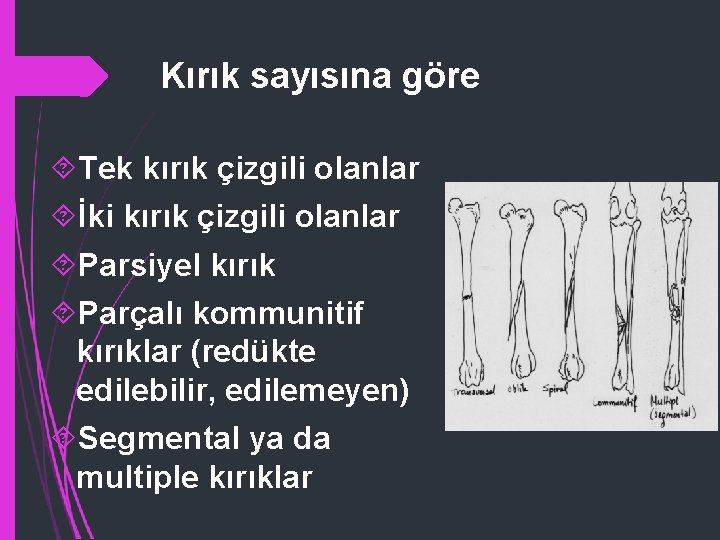 Kırık sayısına göre Tek kırık çizgili olanlar İki kırık çizgili olanlar Parsiyel kırık Parçalı