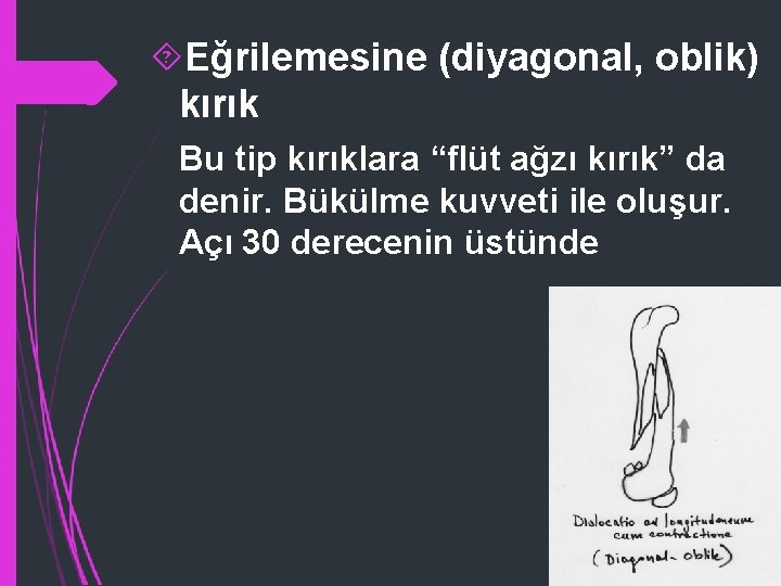  Eğrilemesine (diyagonal, oblik) kırık Bu tip kırıklara “flüt ağzı kırık” da denir. Bükülme