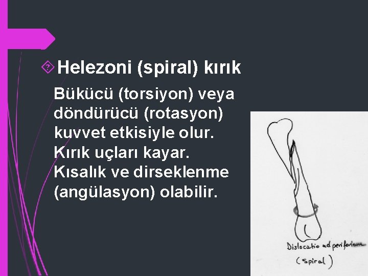  Helezoni (spiral) kırık Bükücü (torsiyon) veya döndürücü (rotasyon) kuvvet etkisiyle olur. Kırık uçları