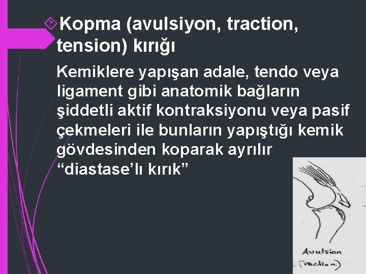  Kopma (avulsiyon, traction, tension) kırığı Kemiklere yapışan adale, tendo veya ligament gibi anatomik