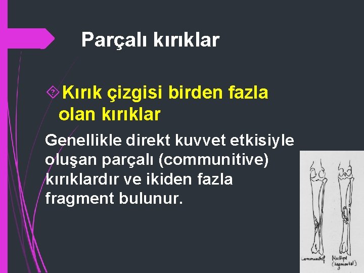 Parçalı kırıklar Kırık çizgisi birden fazla olan kırıklar Genellikle direkt kuvvet etkisiyle oluşan parçalı