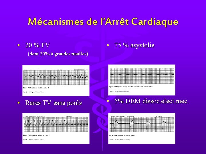 Mécanismes de l’Arrêt Cardiaque • 20 % FV • 75 % asystolie (dont 25%