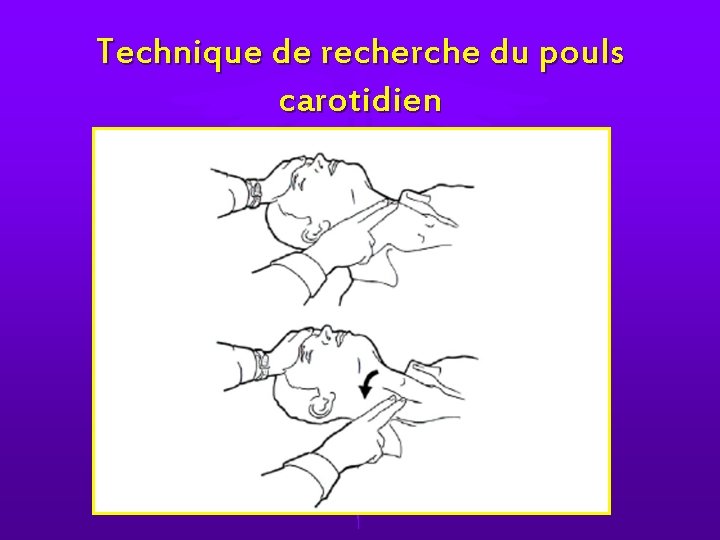 Technique de recherche du pouls carotidien Technique de recherche du pouls carotidien